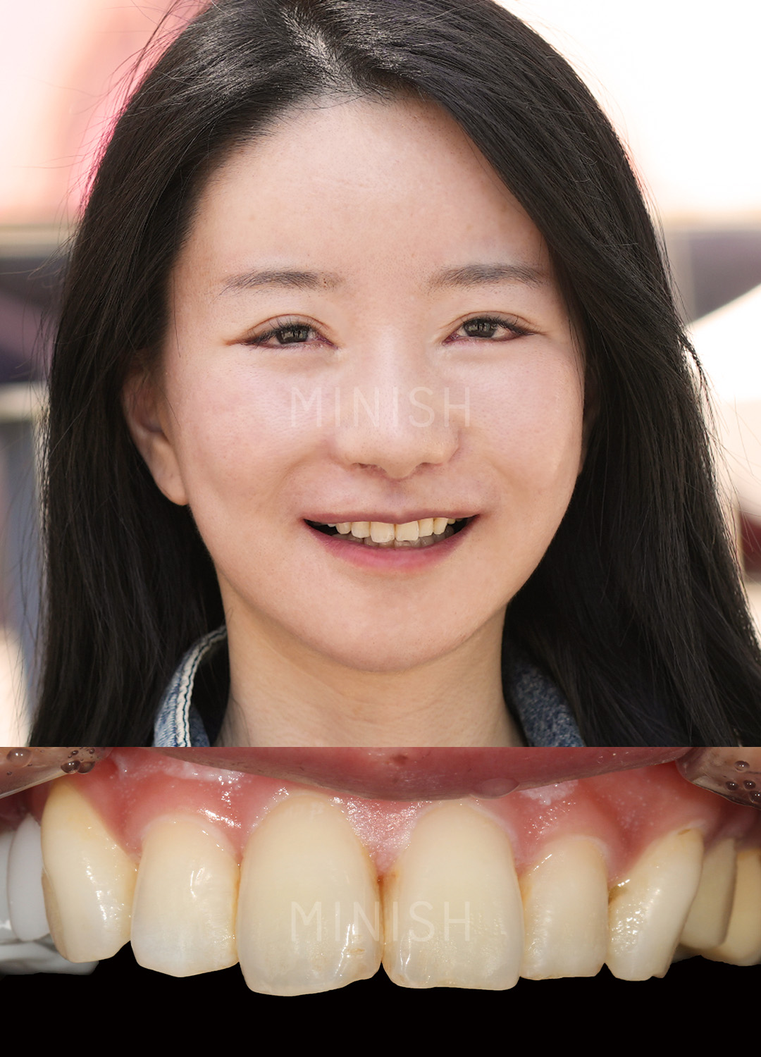Close-up of natural teeth with minor misalignment and uneven shade before MINISH dental treatment.