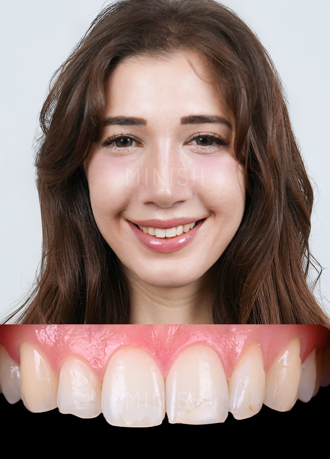 Portrait of a male patient with a close-up of natural teeth showing minor gaps and discoloration before MINISH veneers.