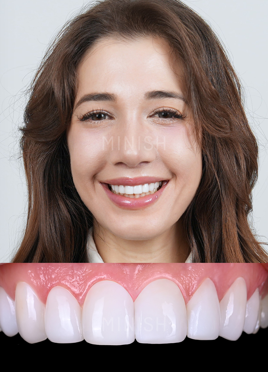 A smiling patient showcasing bright, symmetrical MINISH veneers with a high-definition close-up of the final results.