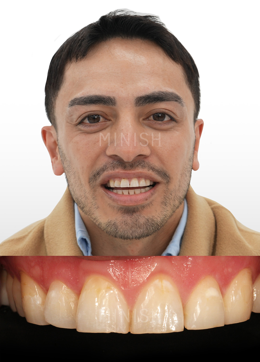A man smiling next to a close-up of natural teeth before receiving MINISH dental veneers.