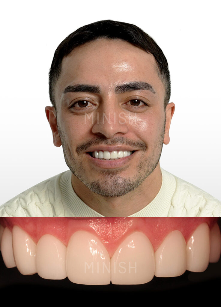Close-up of a patient smile reveal after a minimally invasive MINISH veneer treatment, showing a natural finish and preserved tooth enamel.
