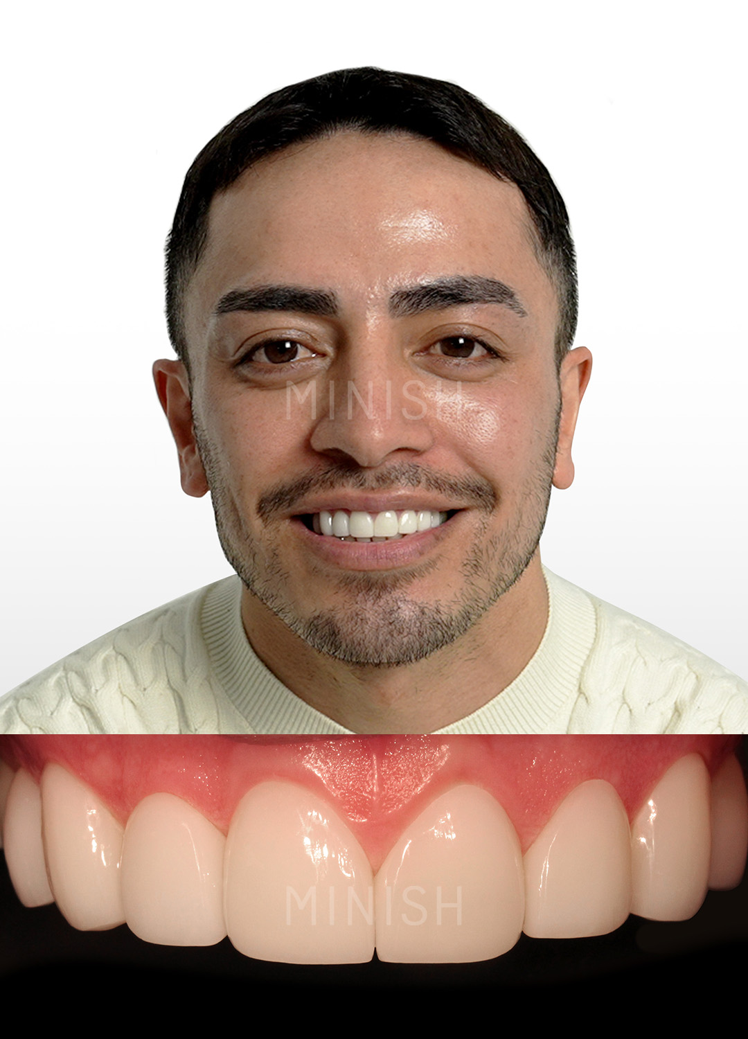 Close-up of a patient smile reveal after a minimally invasive MINISH veneer treatment, showing a natural finish and preserved tooth enamel.