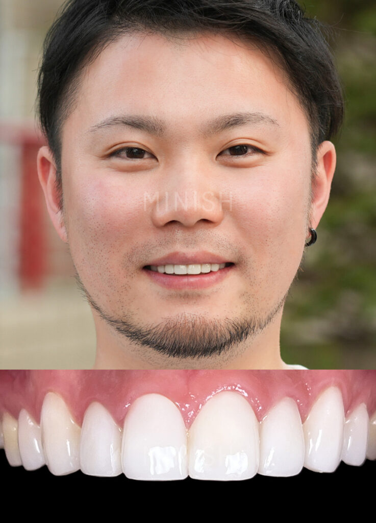 A man smiling with a close-up detail of white, symmetrical MINISH veneers after treatment.