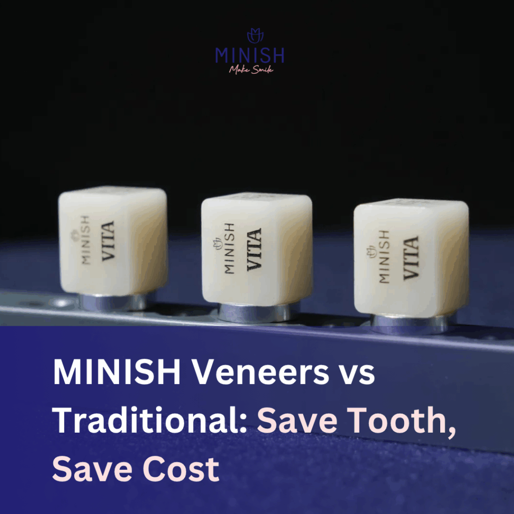 MINISH Veneers