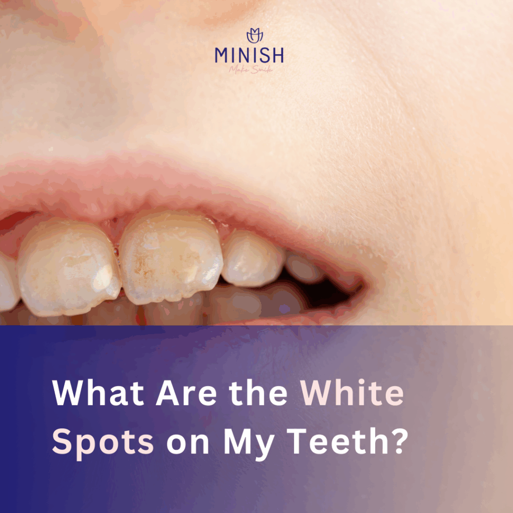 Teeth before MINISH veneers.