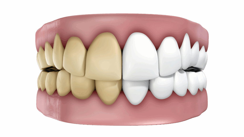 A 3D dental illustration showing a half-yellowed and half-bright white smile to demonstrate the whitening effect of MINISH veneers.