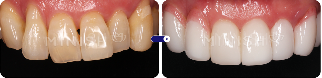 gum recession with exposed tooth root