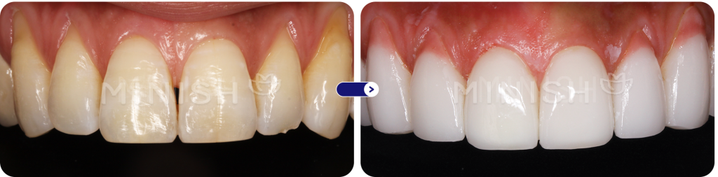 Pink MINISH for gum recession