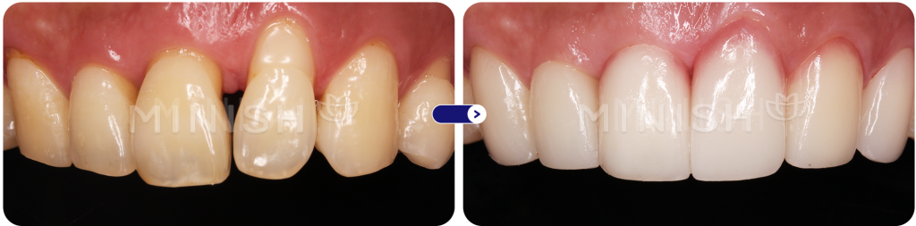 gum recession with exposed tooth root