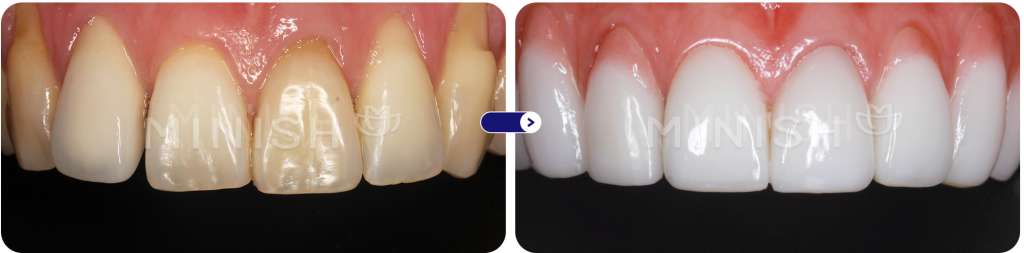 Pink MINISH for gum recession